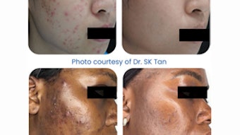 Advanced Laser Device Targets Acne Effectively